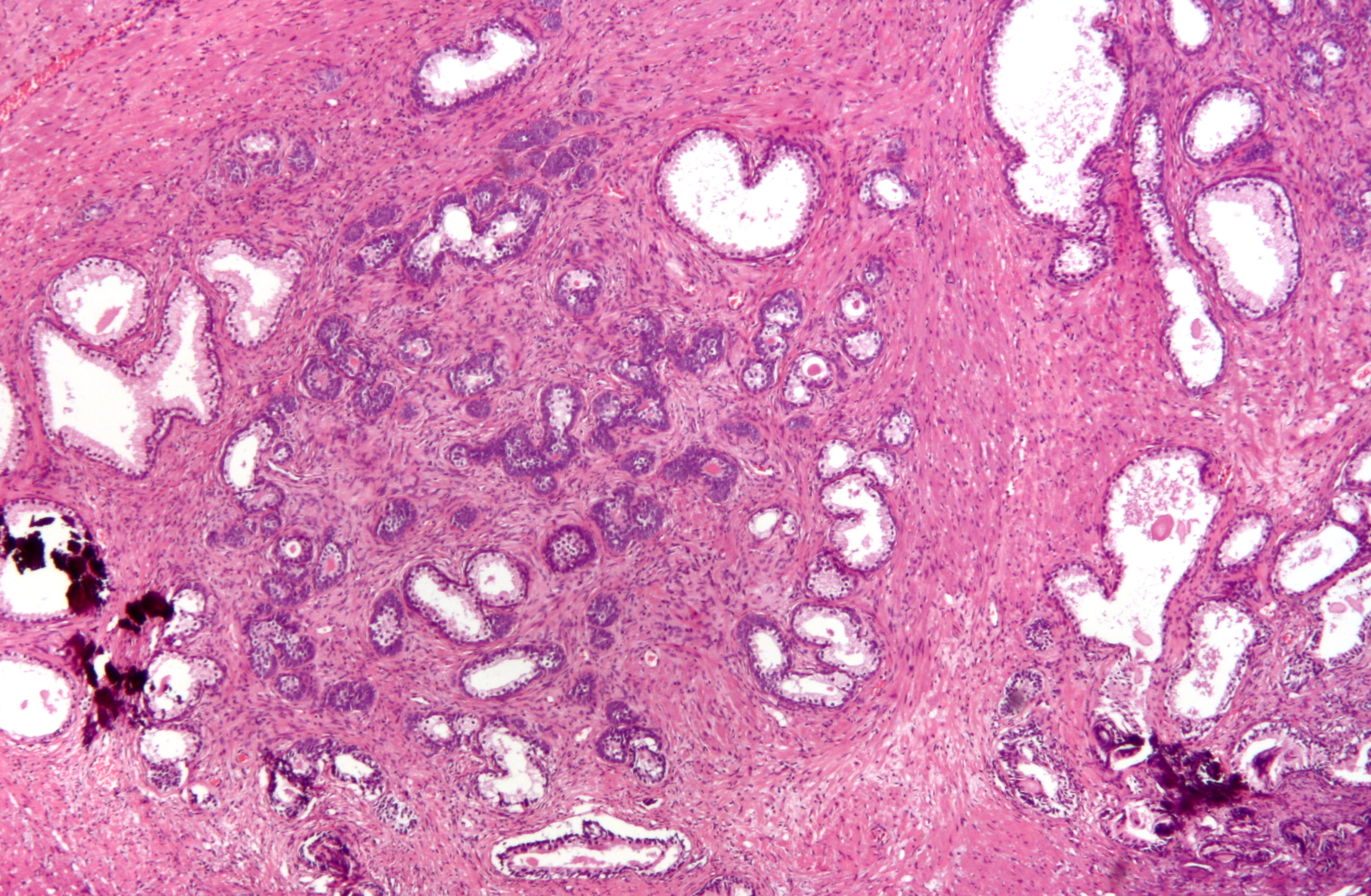 A papillary urothelial neoplasm