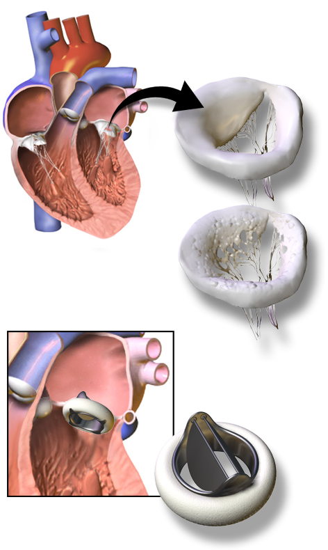 biological heart valve