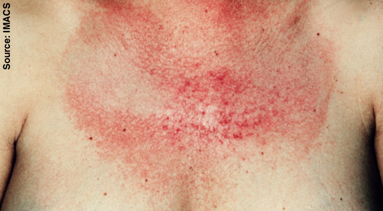 File:Dermatomyositis17.jpg