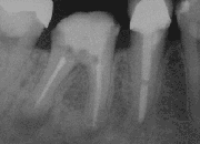 צילום X-Ray של שן לאחר אפיסקטומי