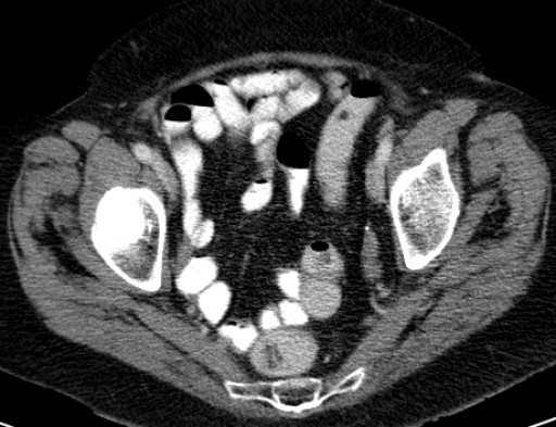 File:Hufeisenniere 02 - CT - axial - 006.jpg