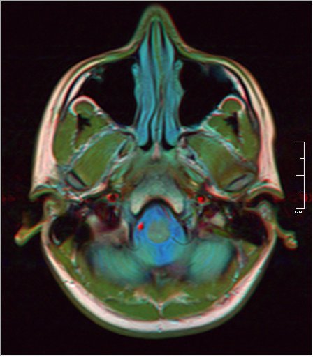 File:Brain MRI 0189 18.jpg