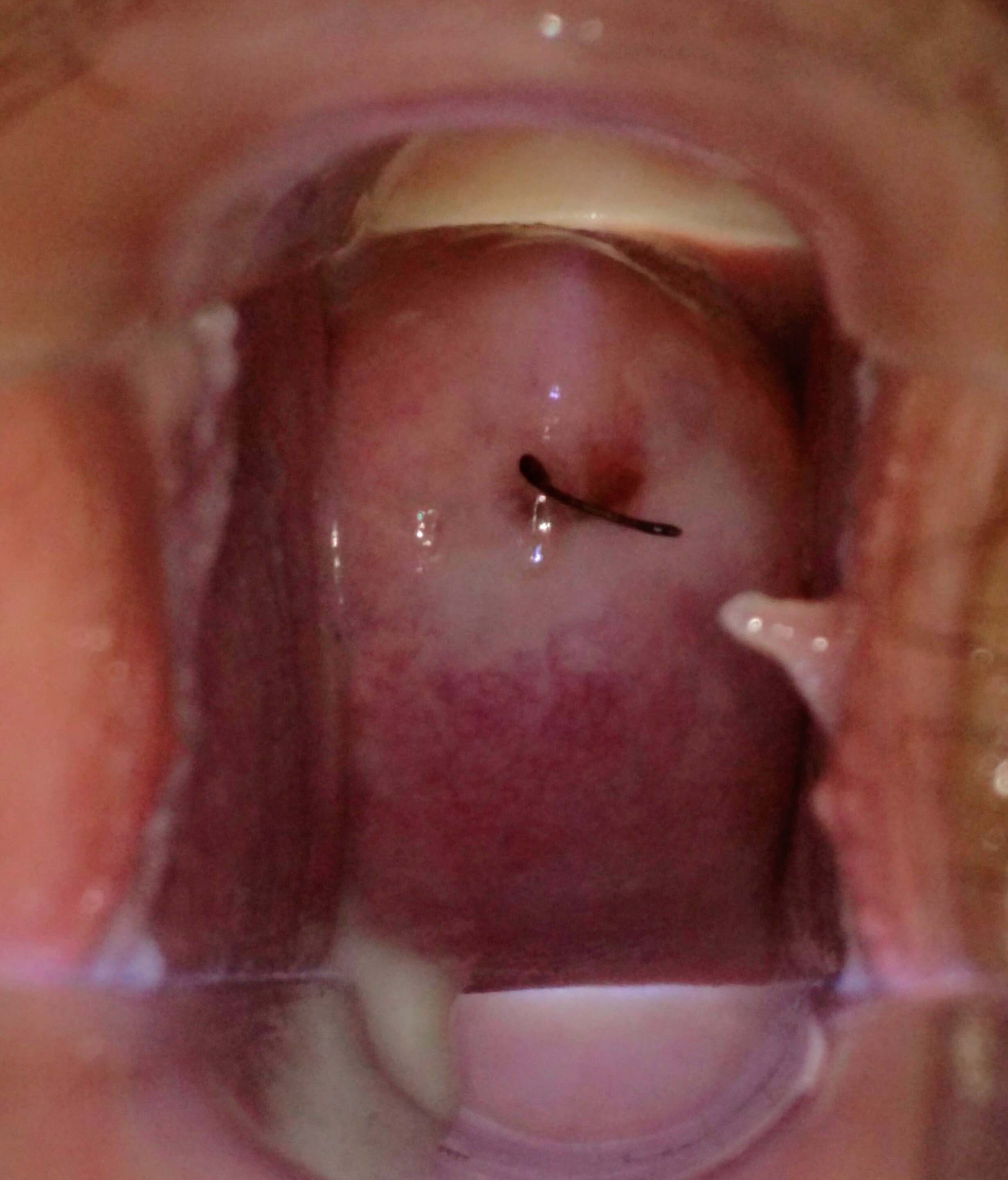 Thick Vaginal Discharge After Sex
