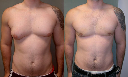 File:Asymmetric Gynecomastia.jpg