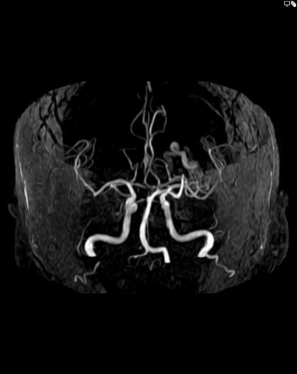 001-Arteriovenous-malformation-TOF-MIP-6