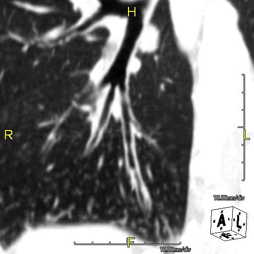 File:Primary ciliary dyskinesia-6.jpg