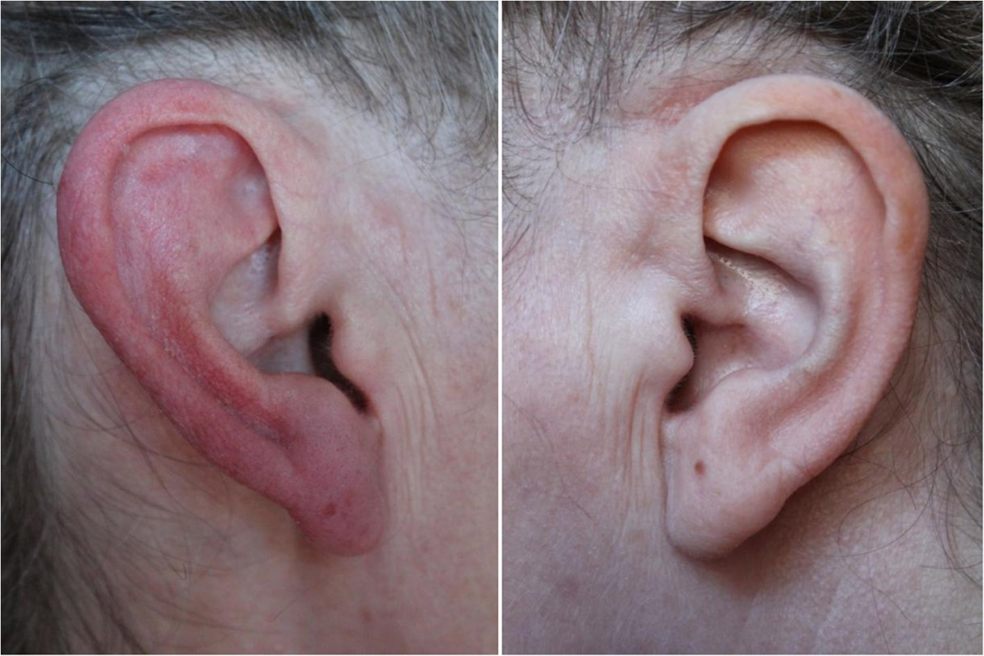 File:Red ear syndrome.jpg - Wikimedia Commons
