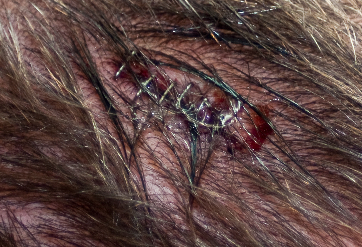 How to Wash Hair With Staples in Head?