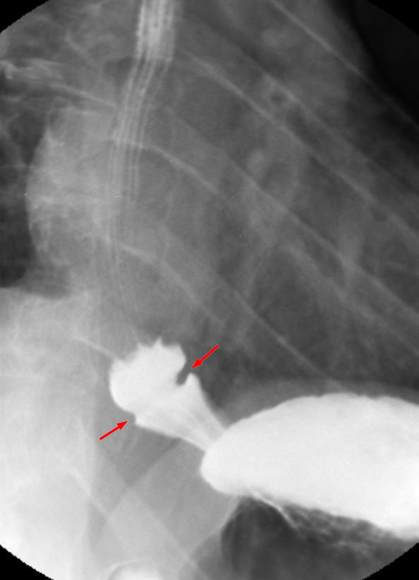 Radiologic Diagnosis of Benign Esophageal Strictures: A Pattern Approach |  RadioGraphics