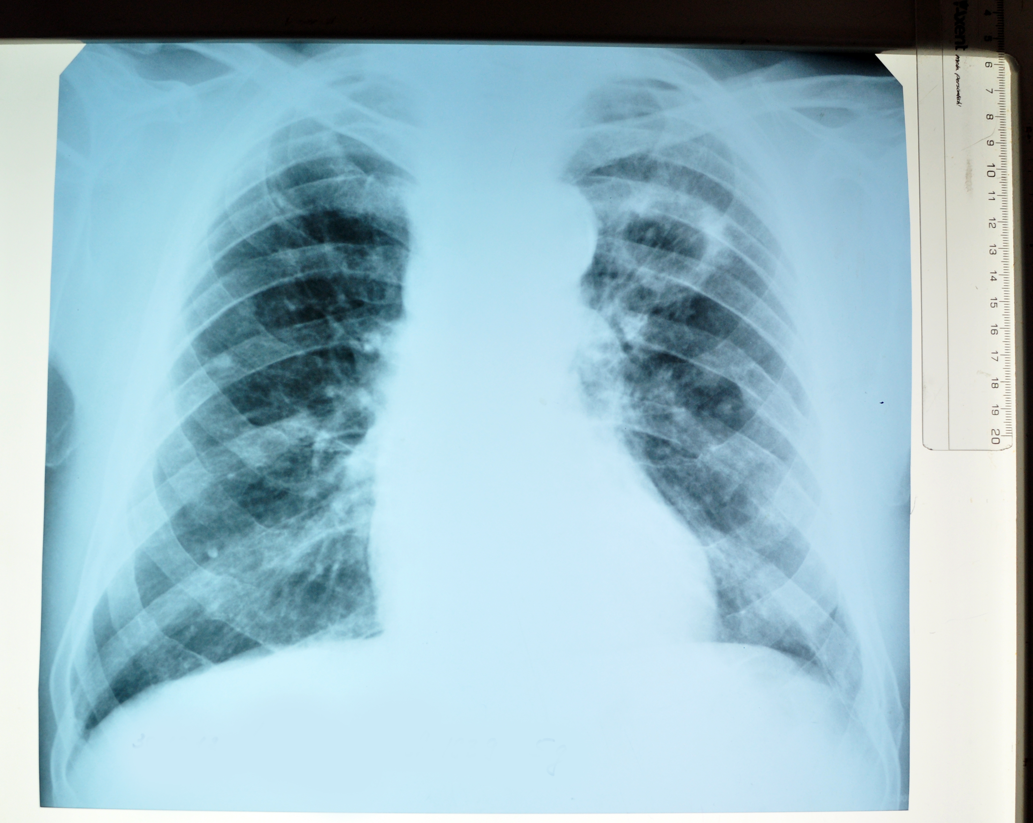 Фиброзно кавернозный туберкулез рентгенограмма