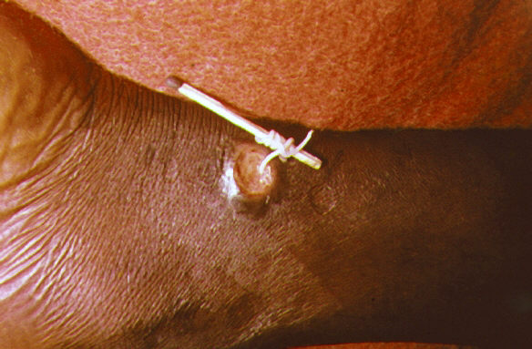 roundworm in humans skin