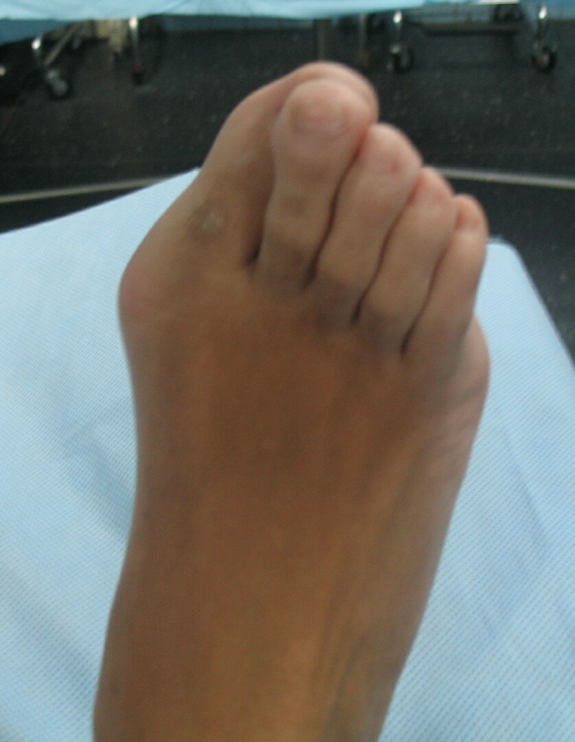 large toe