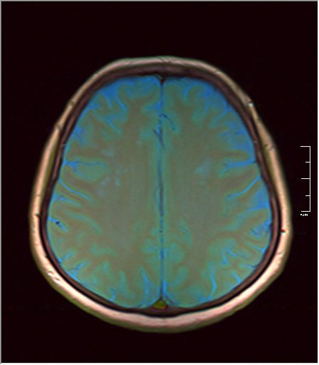 File:Brain MRI 0106 06.jpg