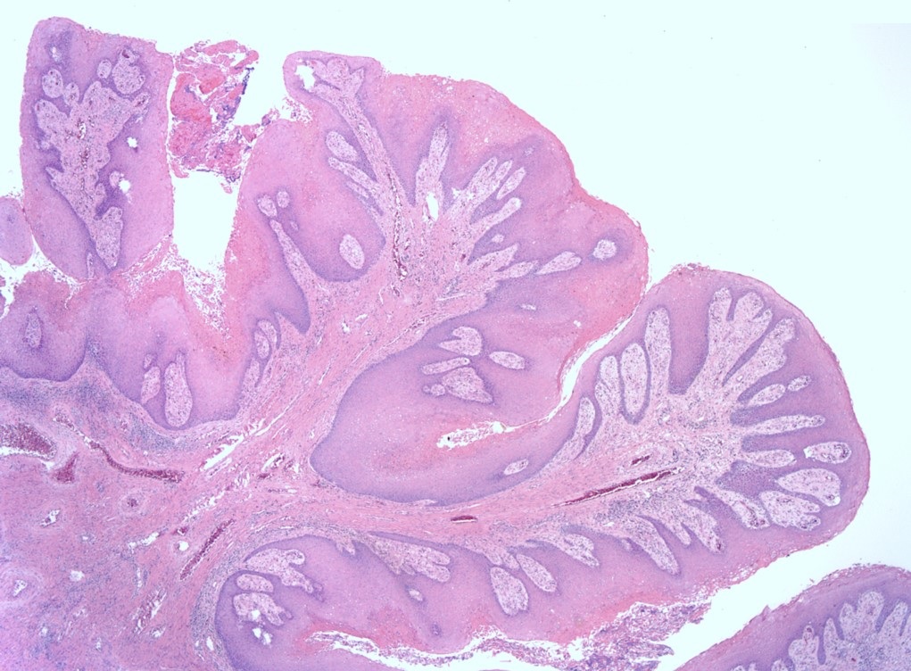 papillomatosis histology