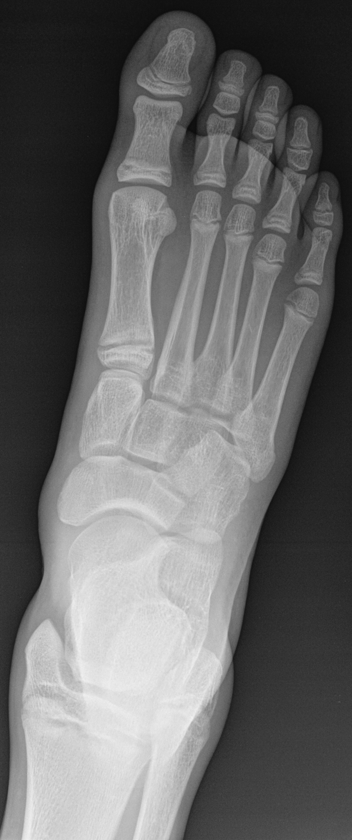 File:X-ray of a normal foot of a 12 year old male - dorsoplantar