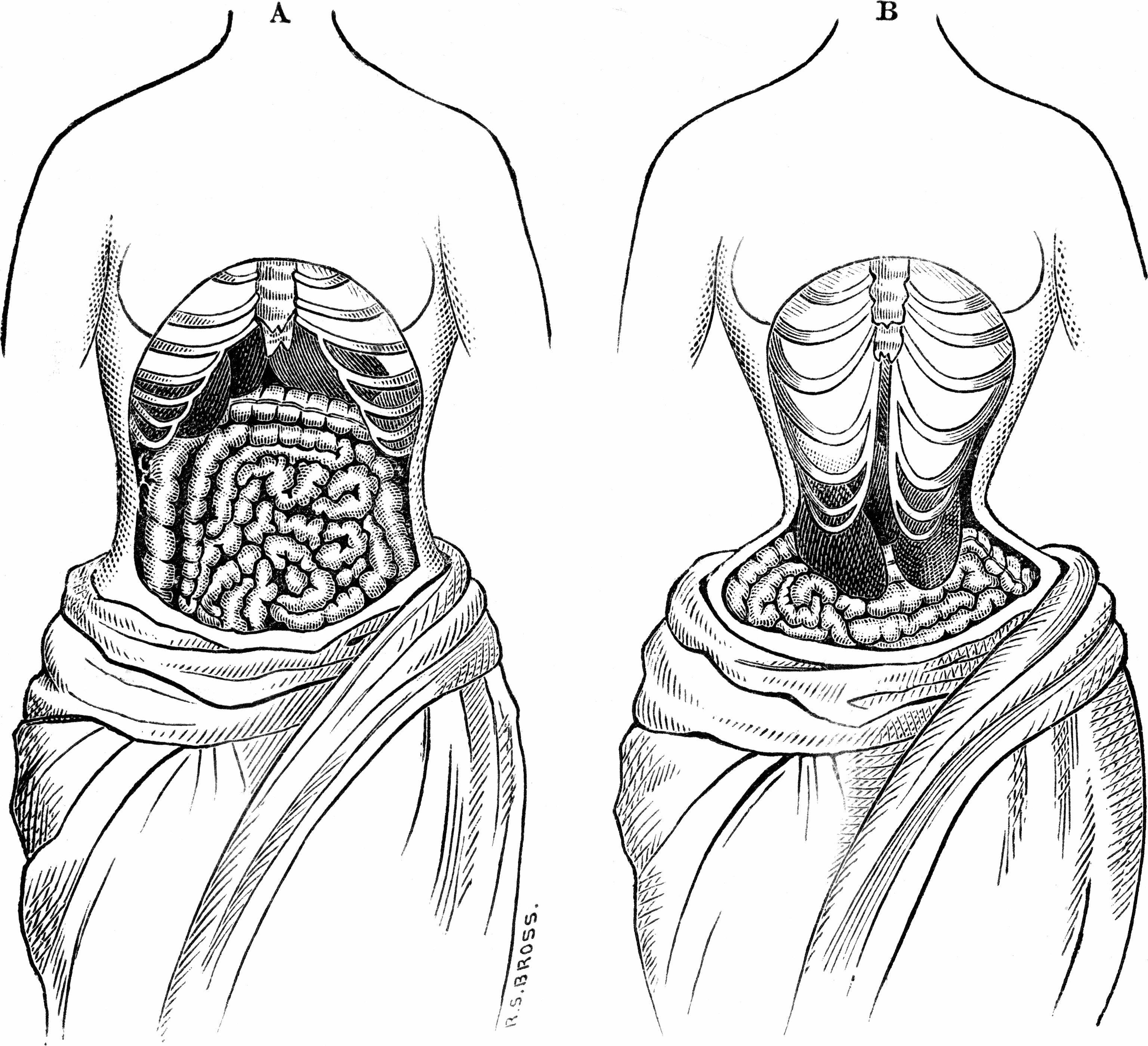 Talk:Tightlacing - Wikipedia