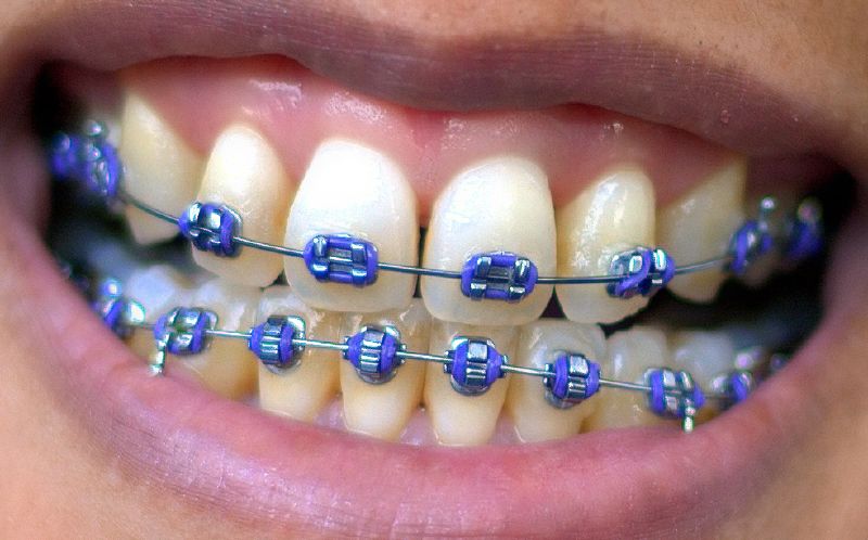 purple and teal braces