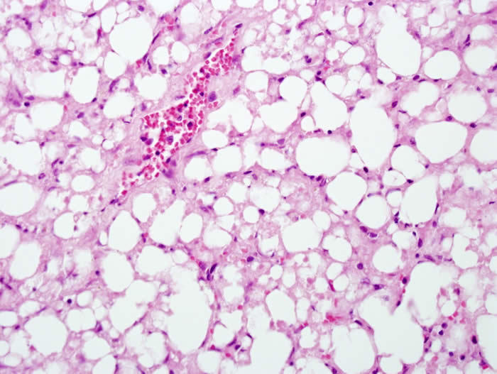 File:Acetominophen toxicity in adult alcoholic Zone 3 necrosis.jpg