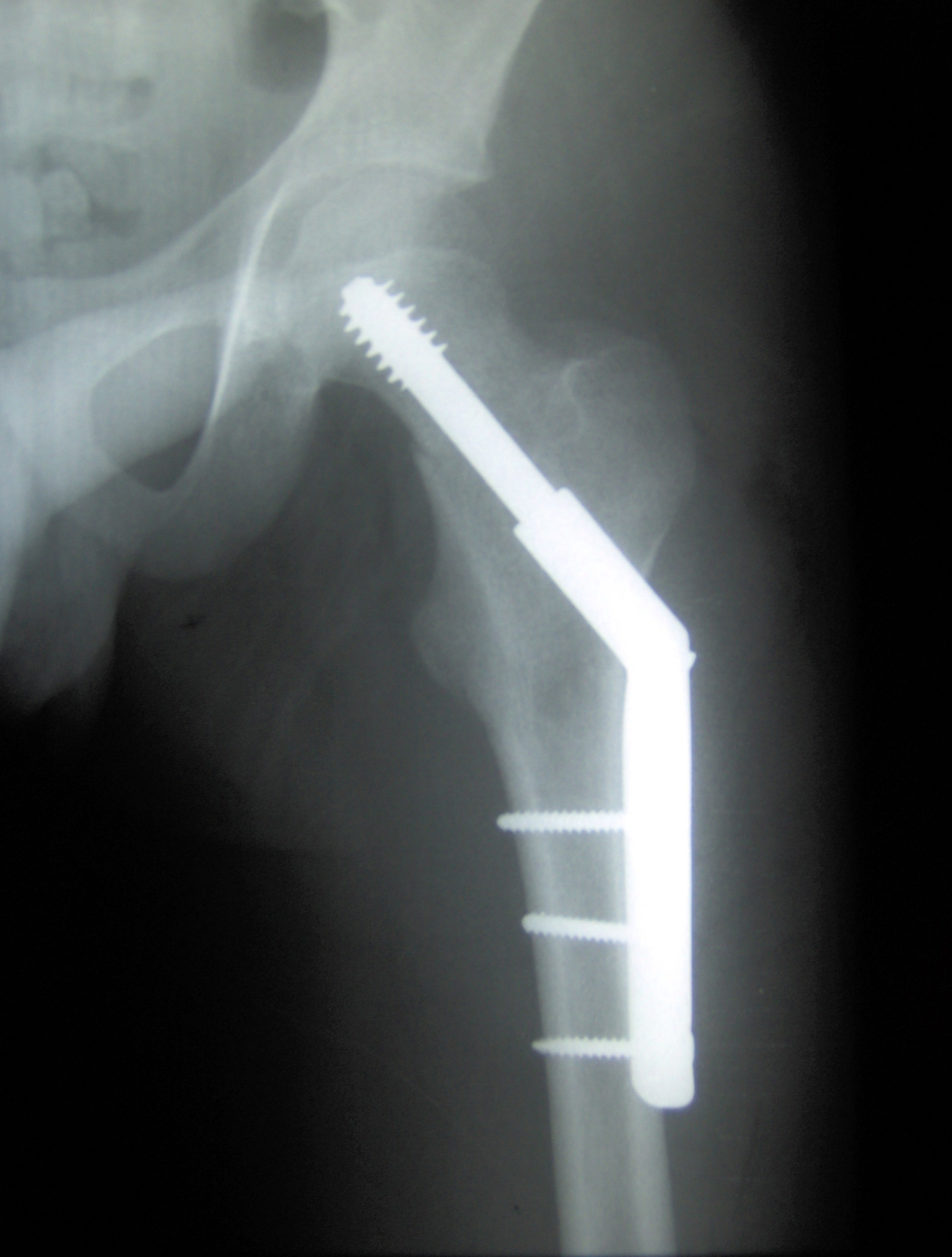 List of orthopedic implants - Wikipedia