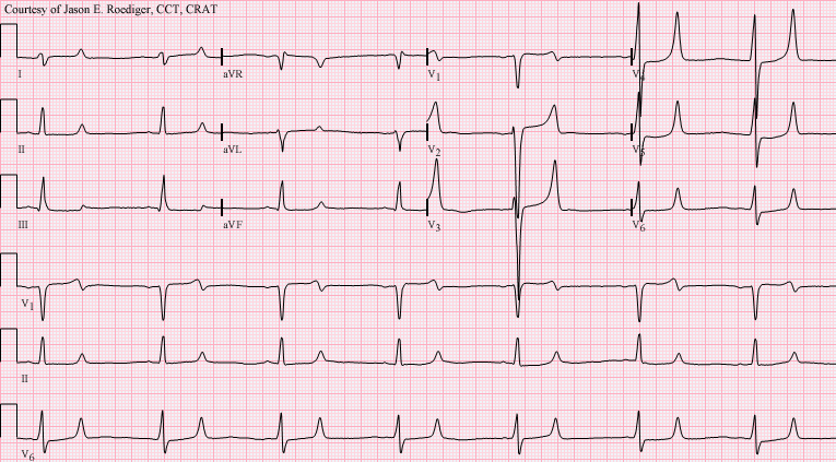 File:Combined hyperkalemia and hypocalcemia.png