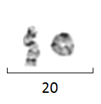 Chromosome 20 en anneau et chromosome 20 normal chez un porteur hétérozygote