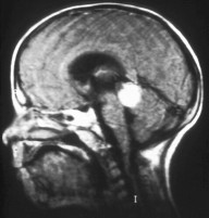 Trilateral retinoblastoma.jpg