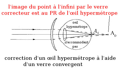 Correction d'un œil hypermétrope n'accommodant pas avec un verre convergent conjuguant le point à l'infini et le punctum remotum '"`UNIQ--postMath-00000112-QINU`"'PR'"`UNIQ--postMath-00000113-QINU`"' de l'œil hypermétrope