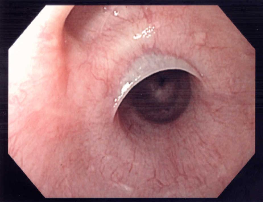 esophageal web barium swallow