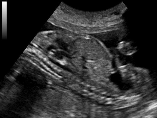 File:Ultrasound Scan ND 111702 1121450 cr.png