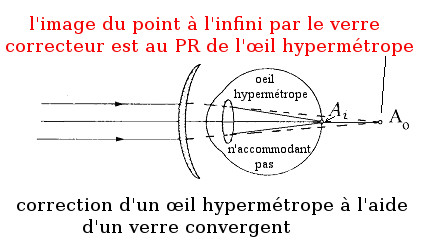 File il hyperm trope corrig par verre convergent.jpg Wikimedia