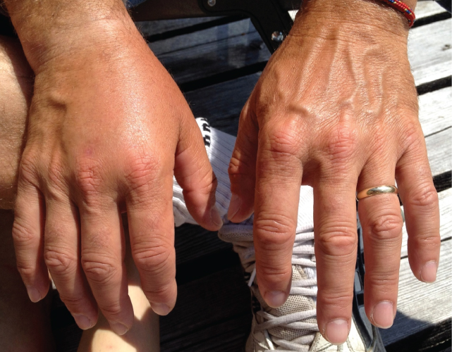 File:2707 Edema of Right Hand Due to Allergic Reaction.jpg