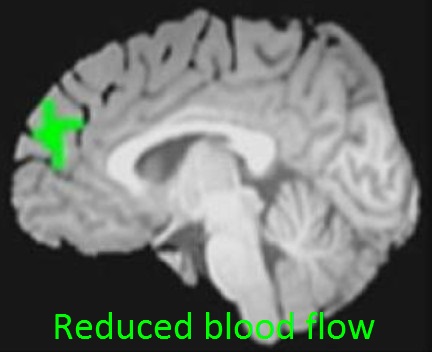 File:Reduced blood flow in cannabis users.jpg