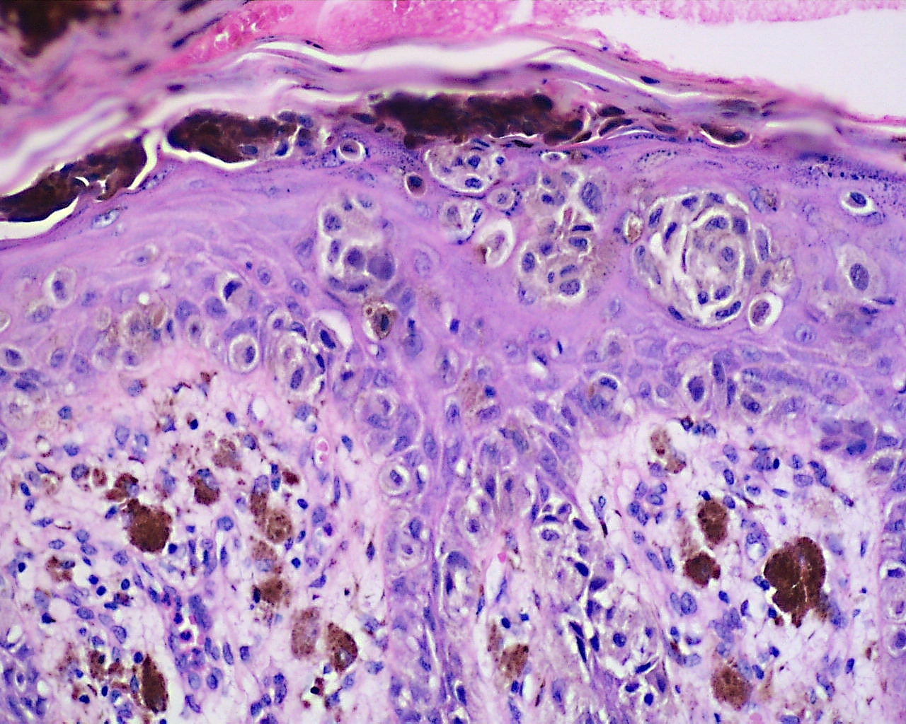 acral lentiginous melanoma histology