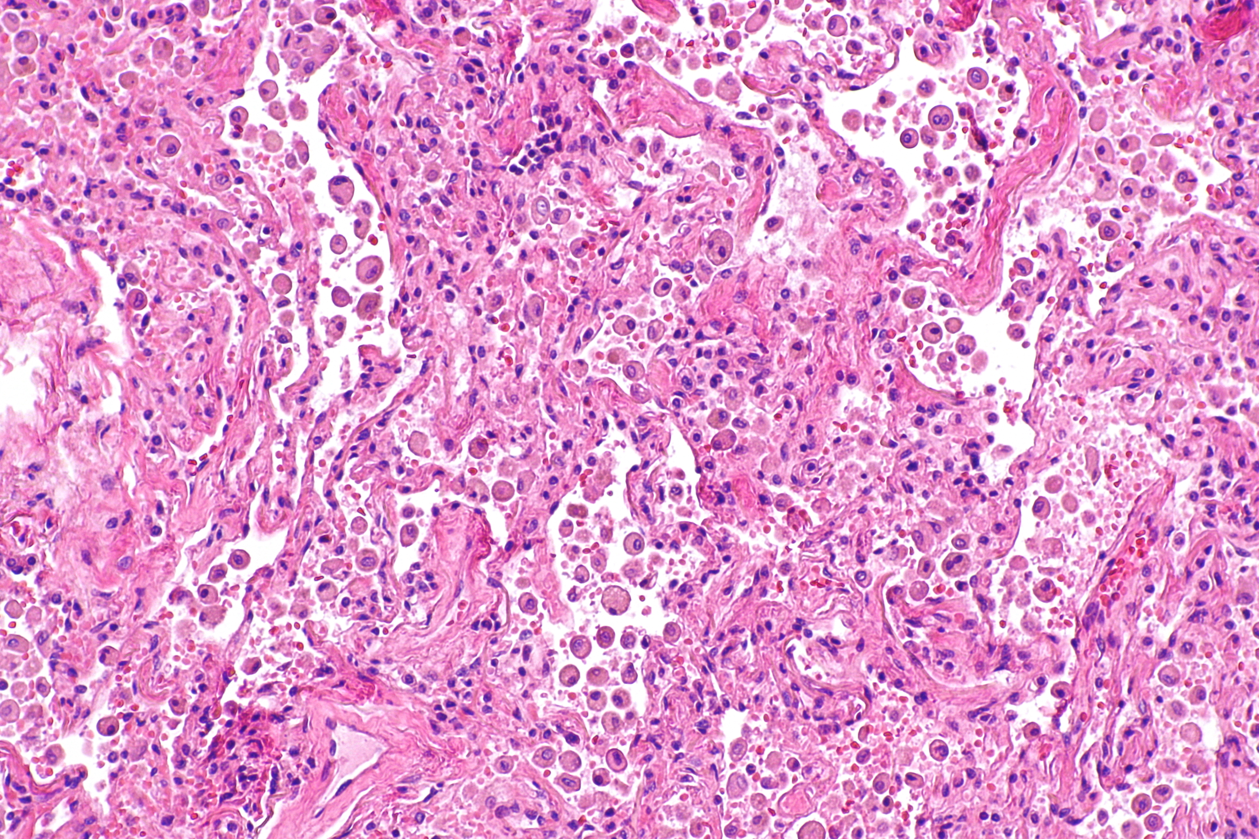 interstitial pneumonia