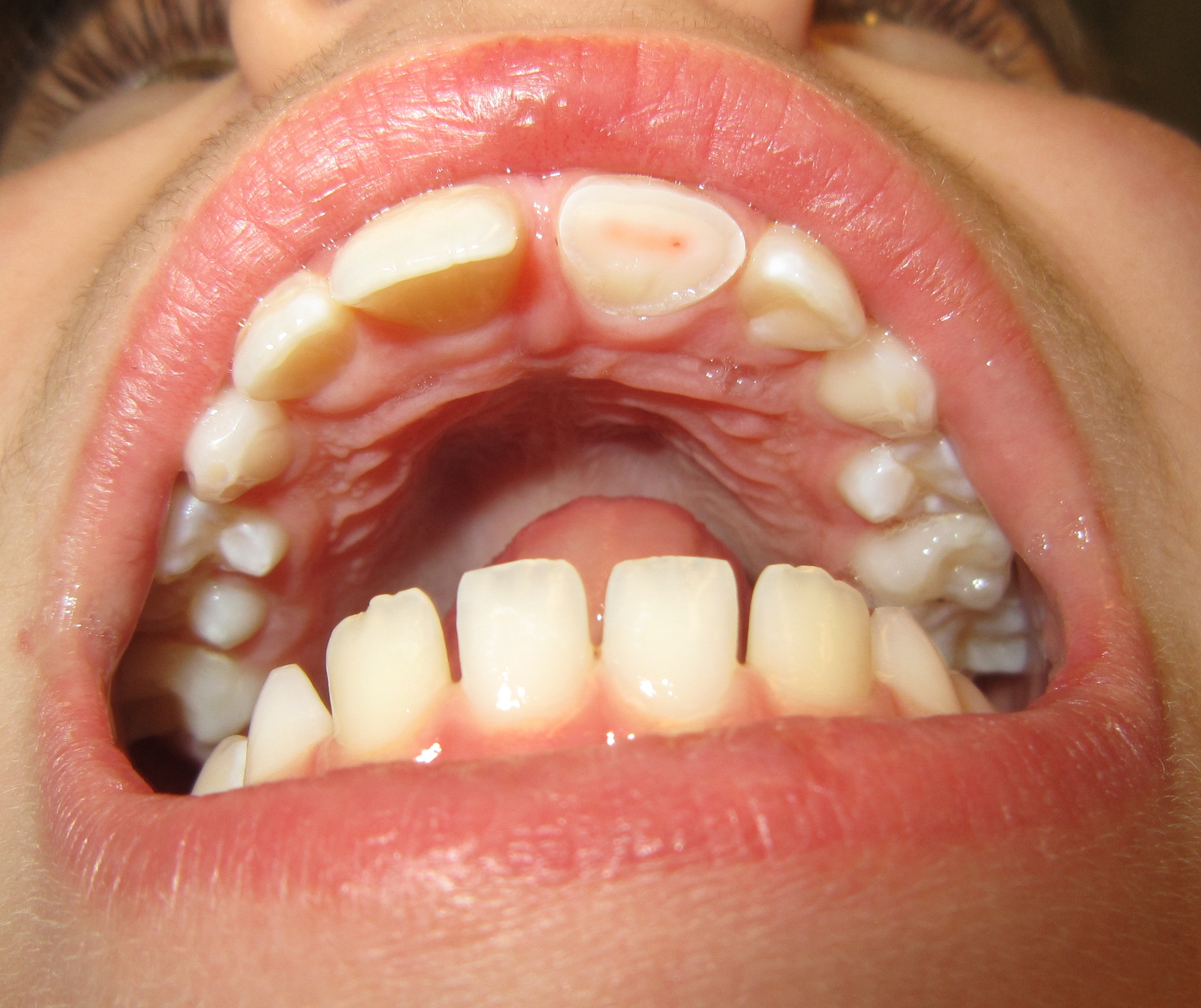 BROKEN TEETH: TRAUMA AND TREATMENT - Serene Dental