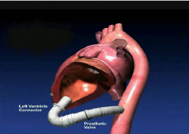 File:Aortic Valve Bypass Configuration.jpg