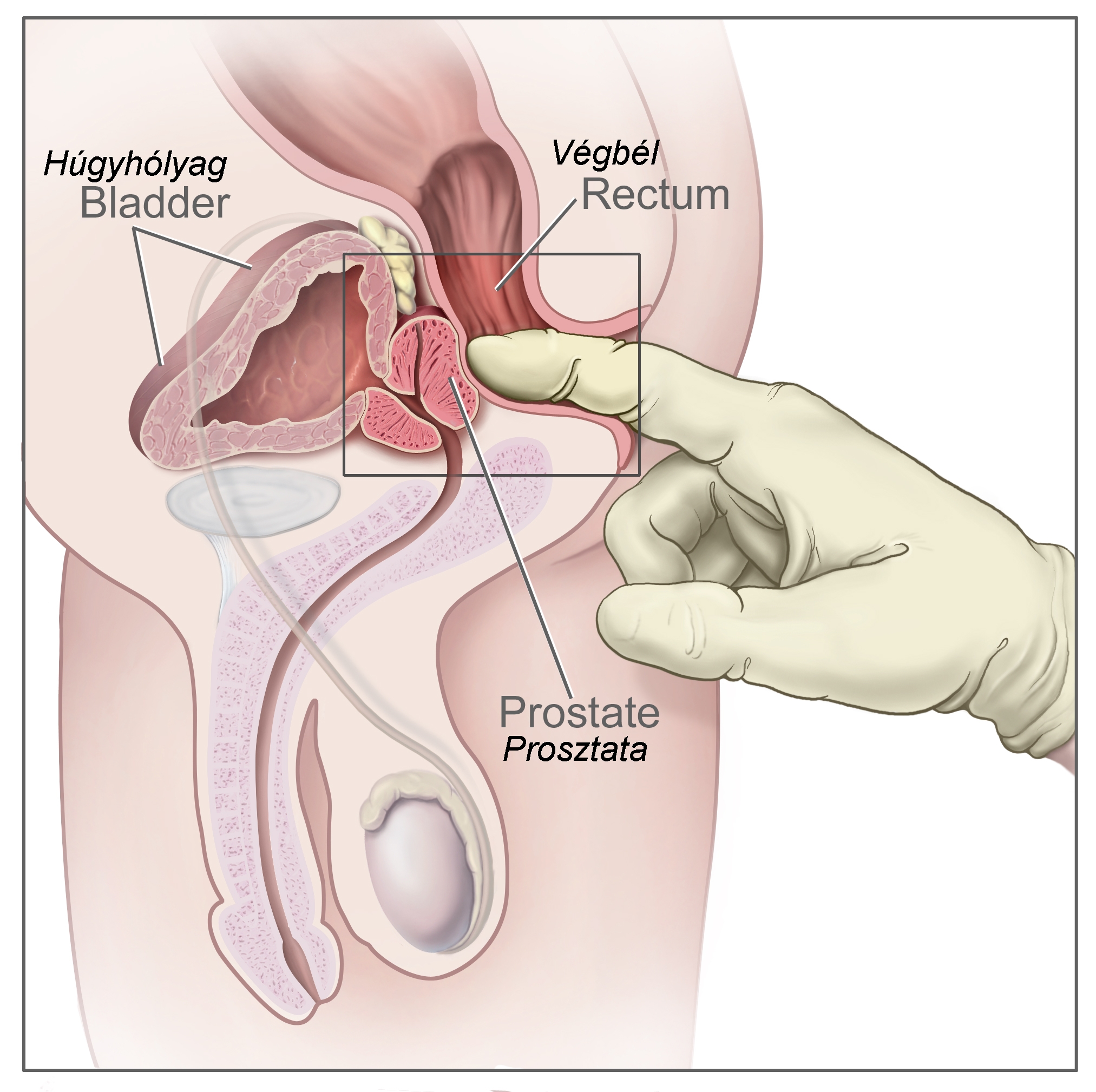 Prostatitis tapintás