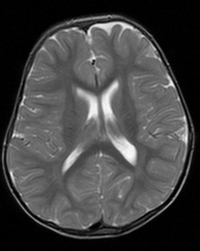 File:Orbitadysplasie bei Neurofibromatose Typ 1 - MRT - T2 axial - 021.jpg