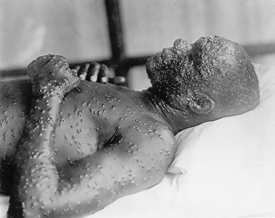 File:Reeve48135 smallpox.jpg