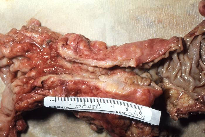 File:Adenocarcinoma, colon, gross pathology 64 lores.jpg