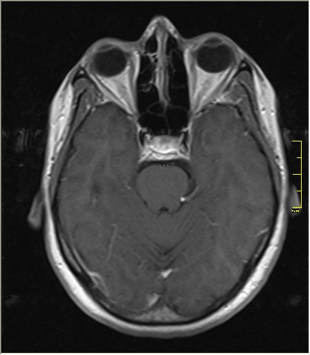 File:Brain MRI glioma 116.jpg