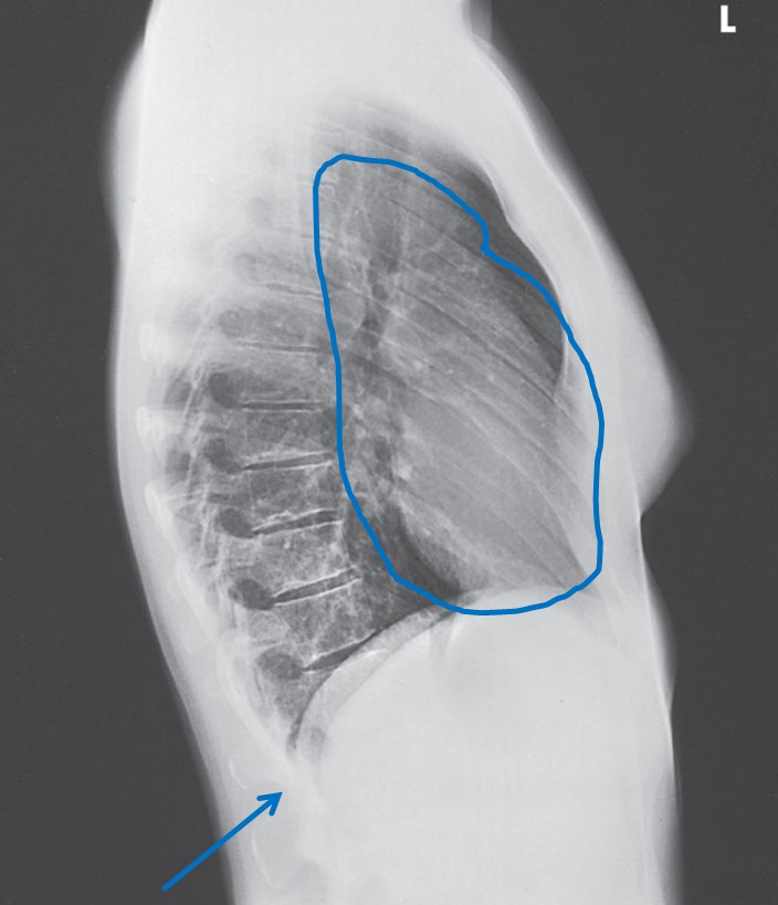 lateral chest xray