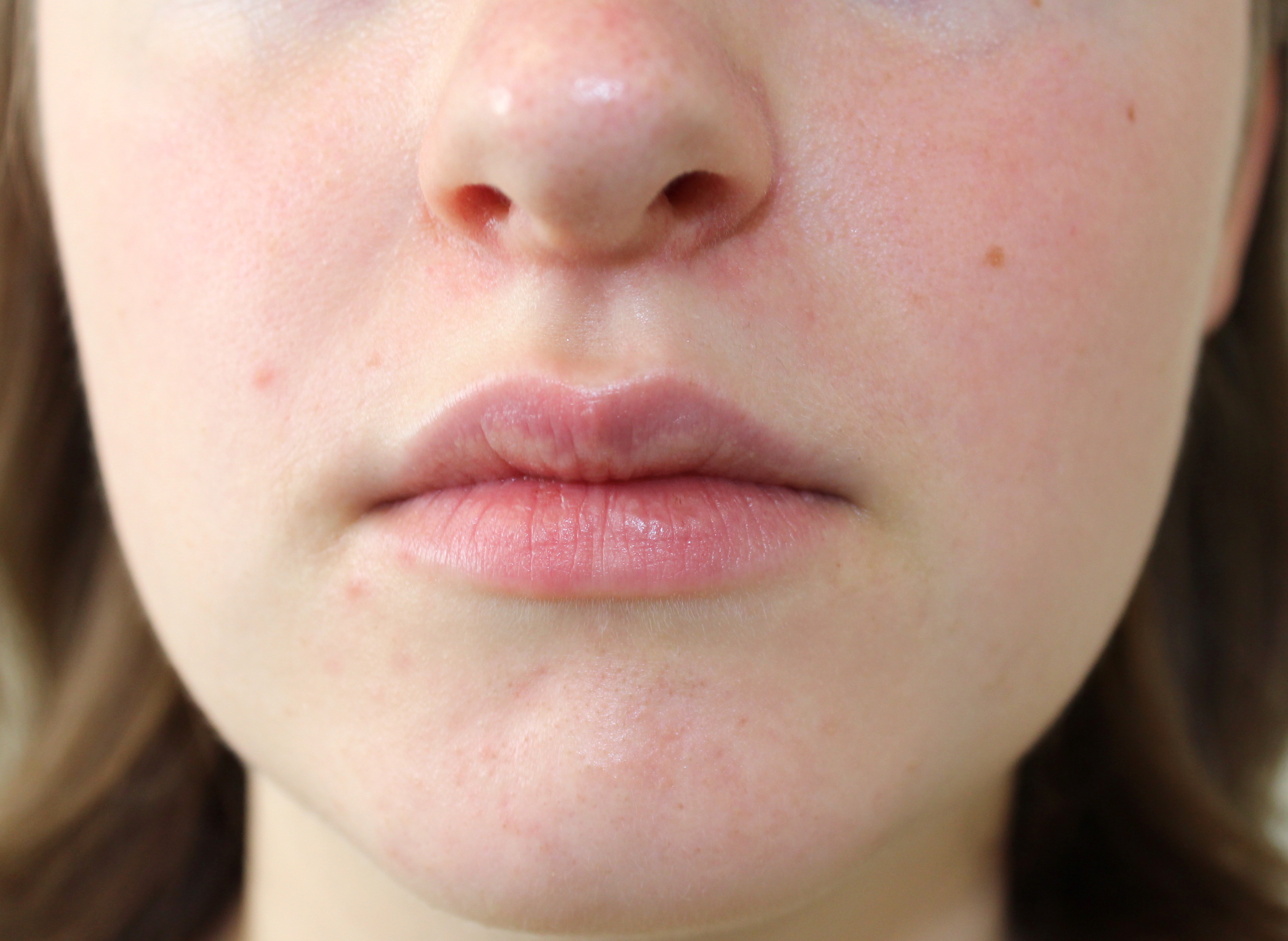 Perioral Dermatitis: Causes, Symptoms, and Treatment