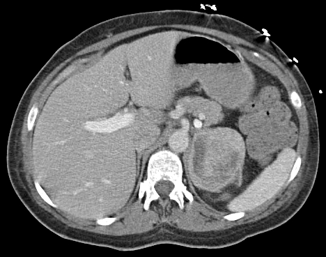 File:Phaeochromozytoma CT.jpg