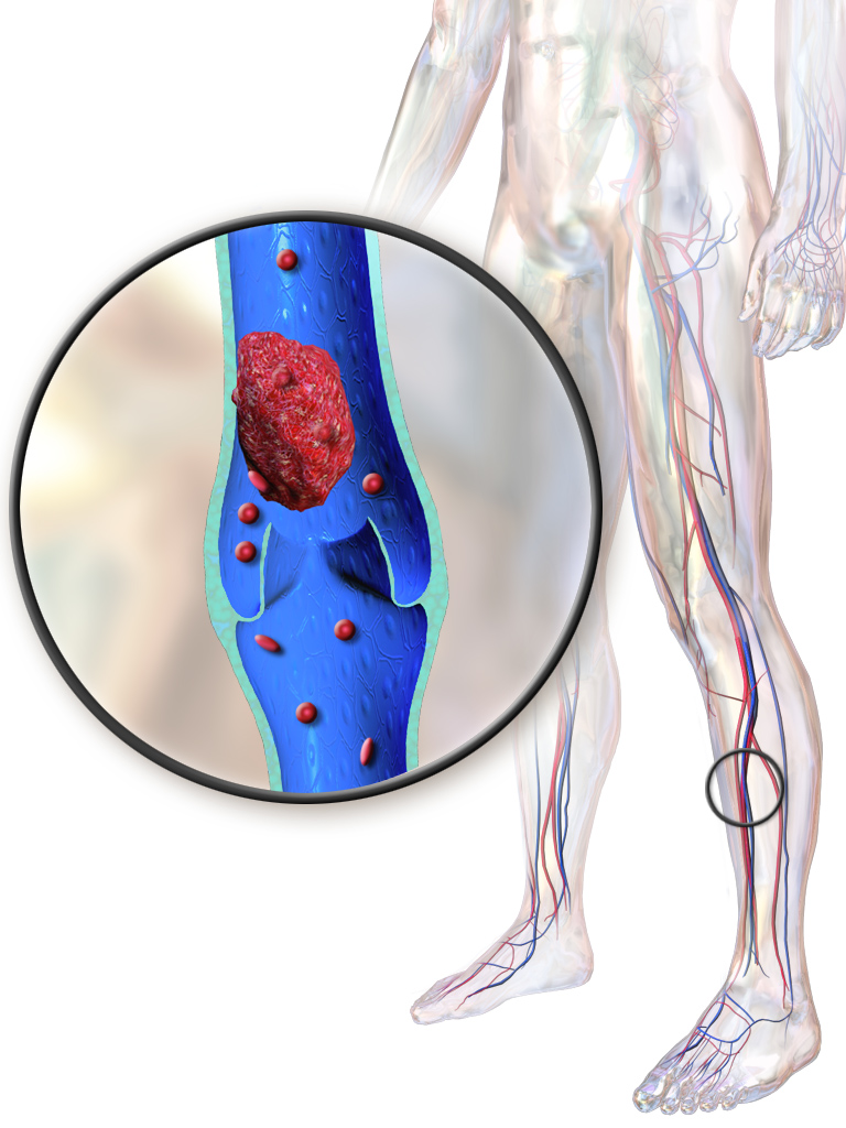 A deep vein thrombus can dislodge and cause pulmonary embolism. (Wikimedia Commons)