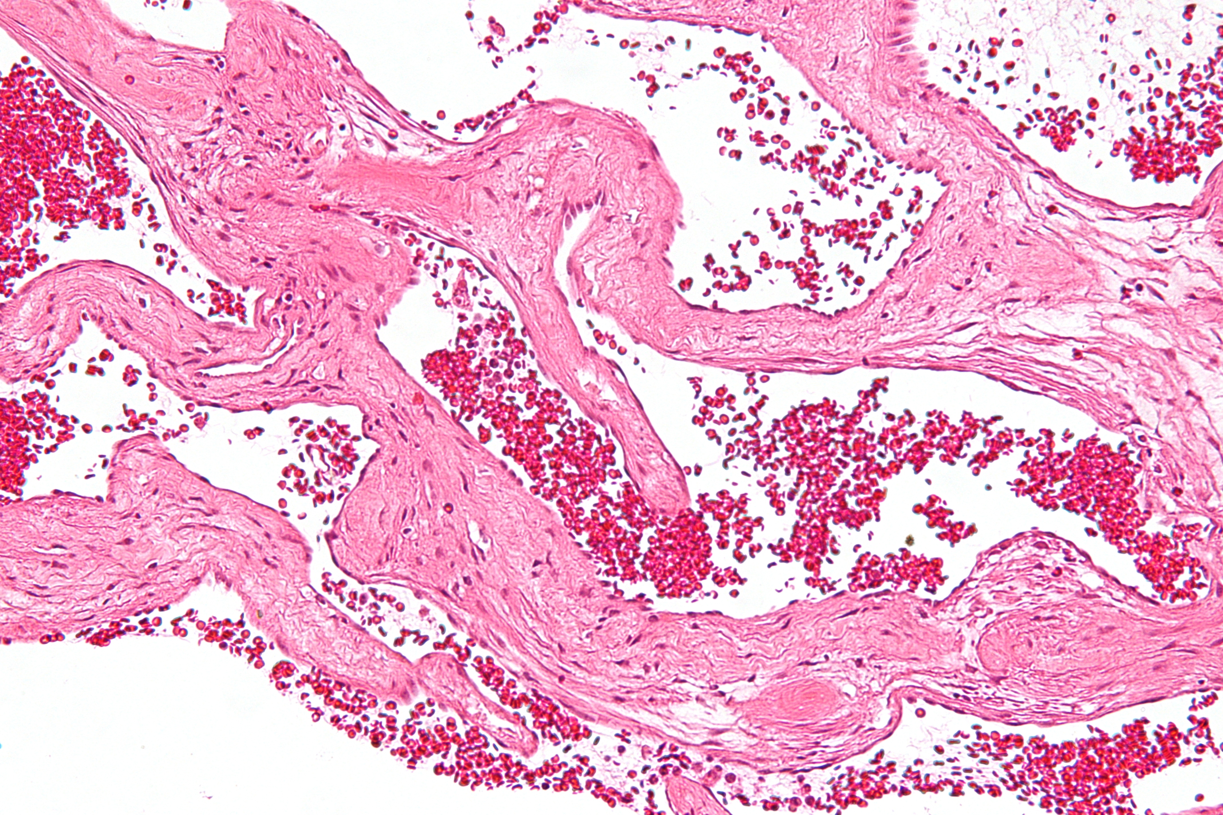 Capillary hemangioma - Wikipedia