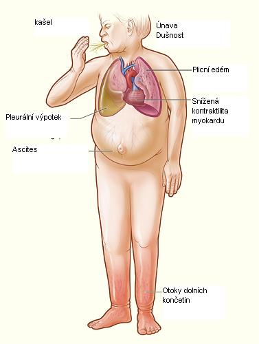 File:Heartfailure-CS.JPG