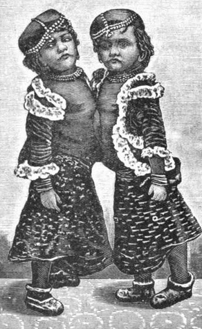 <span class="mw-page-title-main">Radhika and Dudhika Nayak</span> Indian conjoined twins