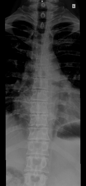 A thoracic spine X-ray of a 57-year-old male.