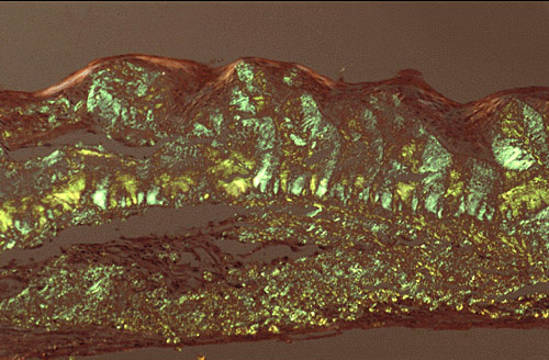 Apple green dichroism of subepithelial deposition of amyloid viewed under polarized light. Congo red stain.